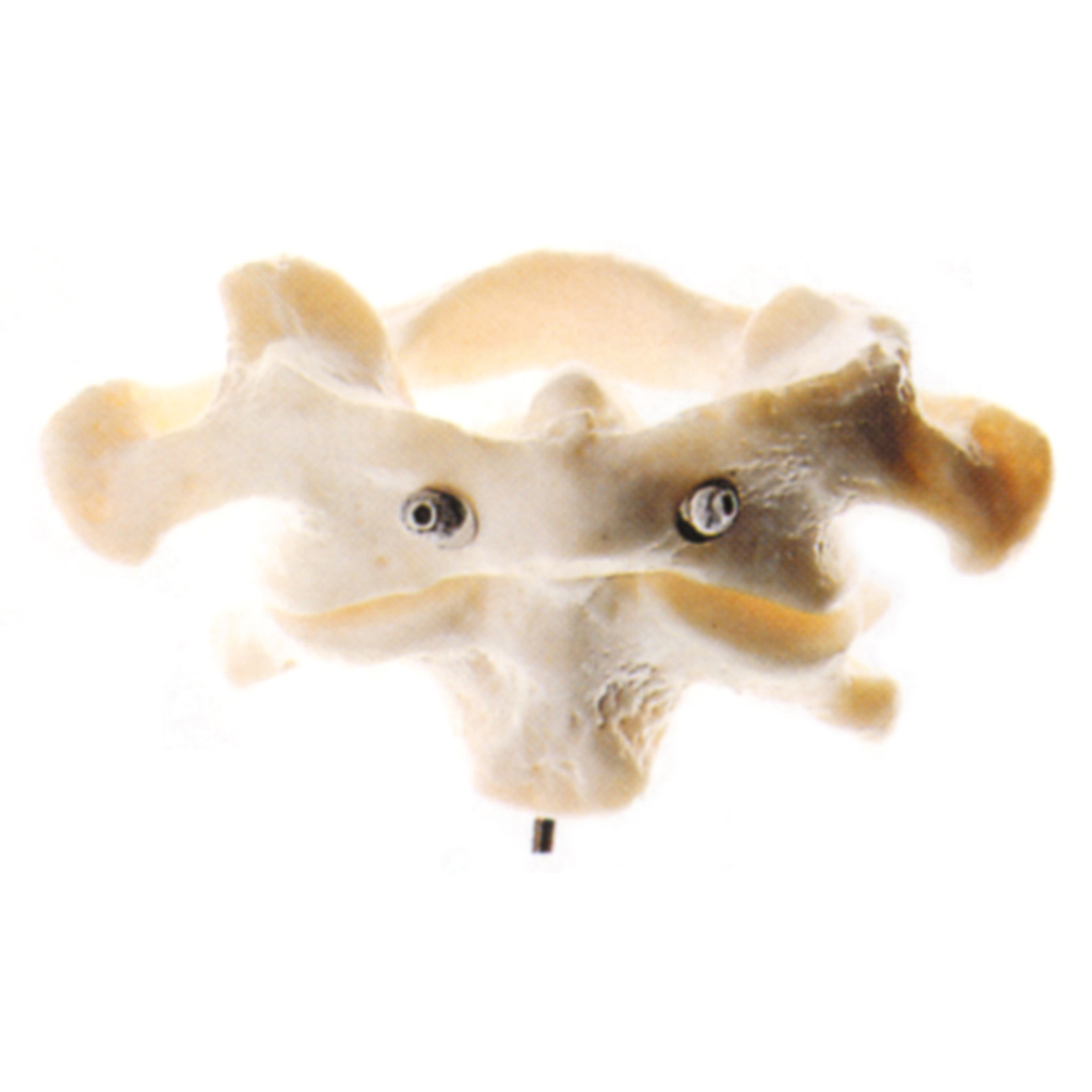 temp2024O91hXgHXKcjL1 Erster und zweiter Halswirbel