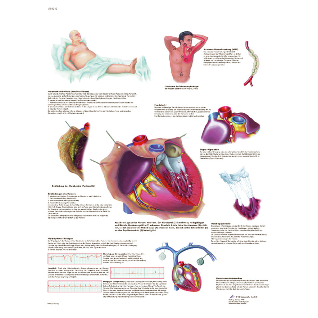 Häufige Herzerkrankungen - Poster