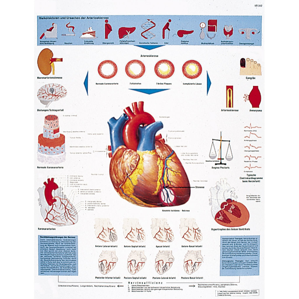 Herzinfarkt - Poster