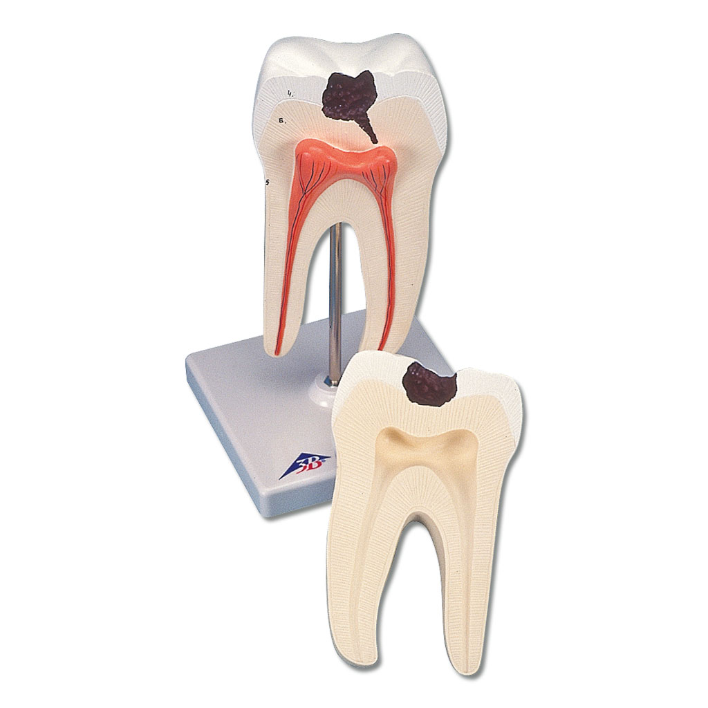 temp2095-backenzahn-karies-modellD7wPv3eodX9uM Zahnmodell vom unteren zweiwurzligen Backenzahn