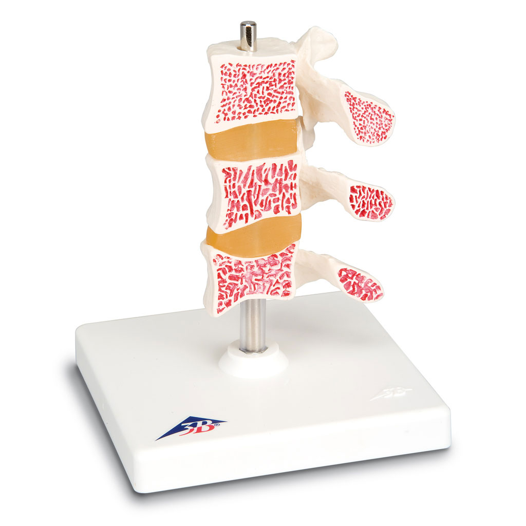 Osteoporose-Wirbelmodell, 3 Wirbel