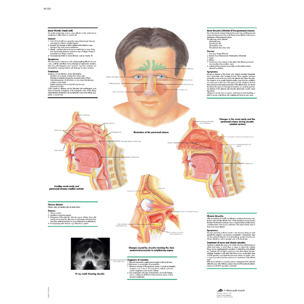 Rhinitis und Sinusitis - Poster