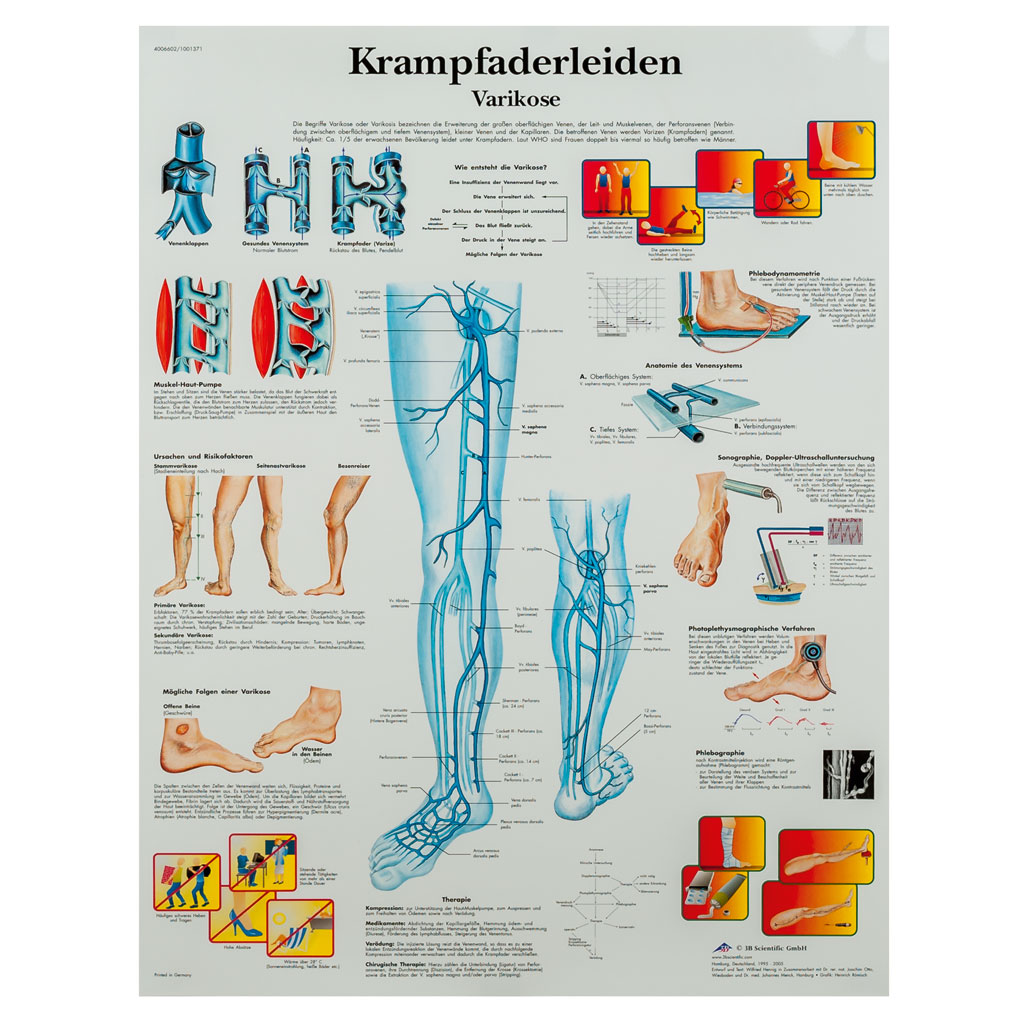 Krampfaderleiden, Varikose - Poster laminiert