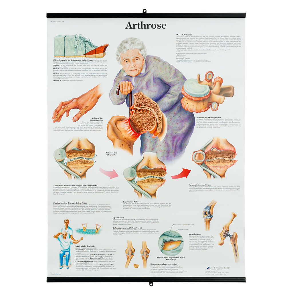 Arthrose - Poster