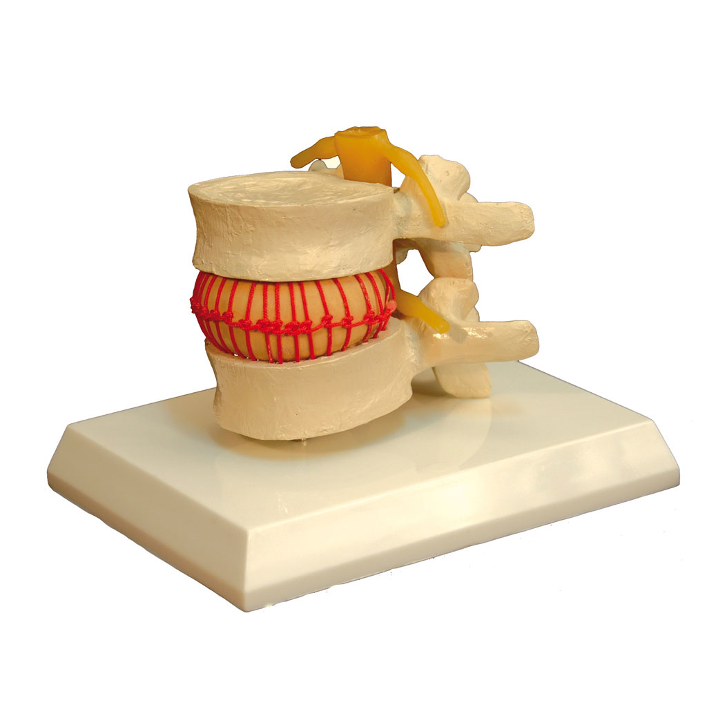 temp22345O57soTH6ocM3D Bandscheiben-Vorfall-Simulator