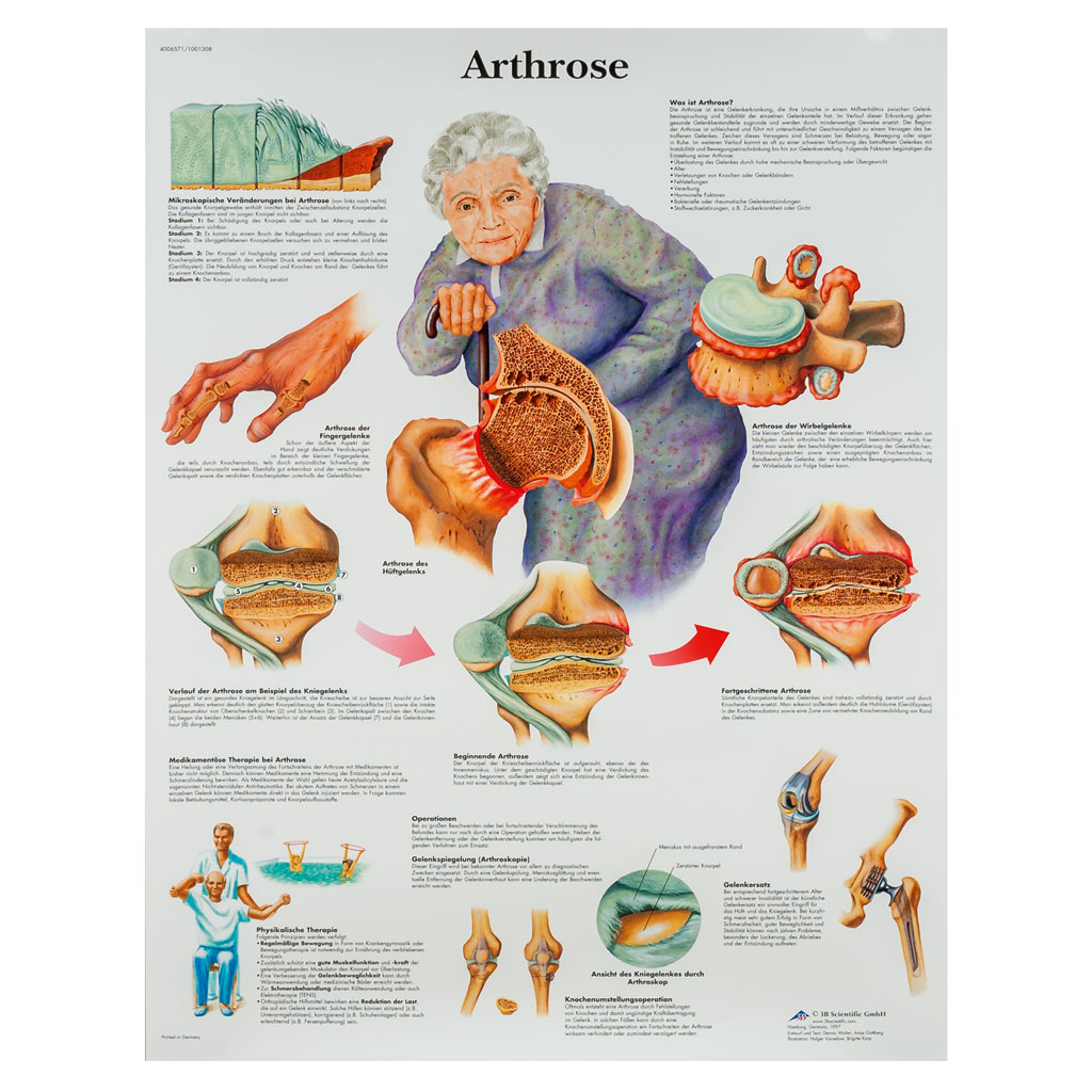 Arthrose - Poster laminiert