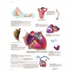Häufige Herzerkrankungen - Poster laminiert